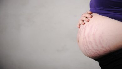 كيف أعالج تشققات الحمل طبيعياً